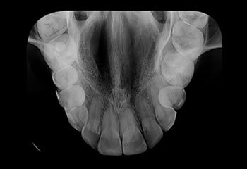 Raio-x-Oclusal
