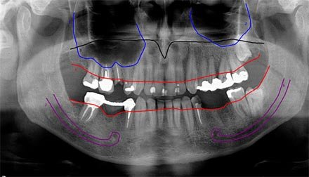 panoramica-com-traçado-É-a-indicação-precisa-através-de-um-traçado-sobre-a-radiografia-panorâmica-das-principais-estruturas-anatômicas-de-interesse-cirúrgico-e-medições-das-est
