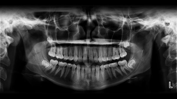 radiografia-panoramica