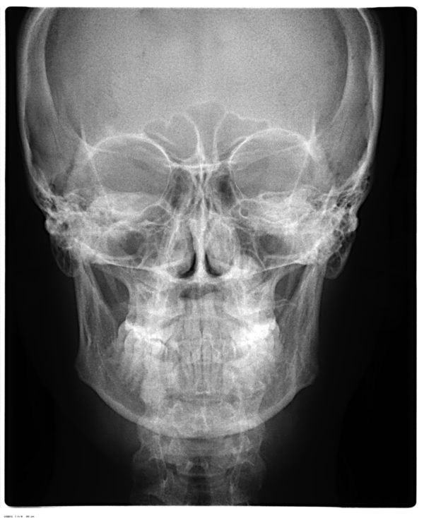 telerradiografia-frontal-cefalometrica-pa-600x734